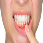 Diş ətinin iltihabı ürək xəstəliyinə səbəb olur