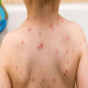 Azərbaycanda qızılca epidemyası ilə bağlı rəsmi açıqlama