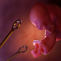 Azərbaycanda abortların sayı 5 minə yaxın artıb