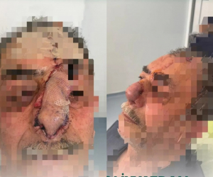 İtin parçaladığı burun bərpa edildi: Azərbaycanda unikal əməliyyat