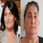 Bu klinika təzminat ödəyəcək - Burun düzəldəndə gözü zədələyib – FOTO